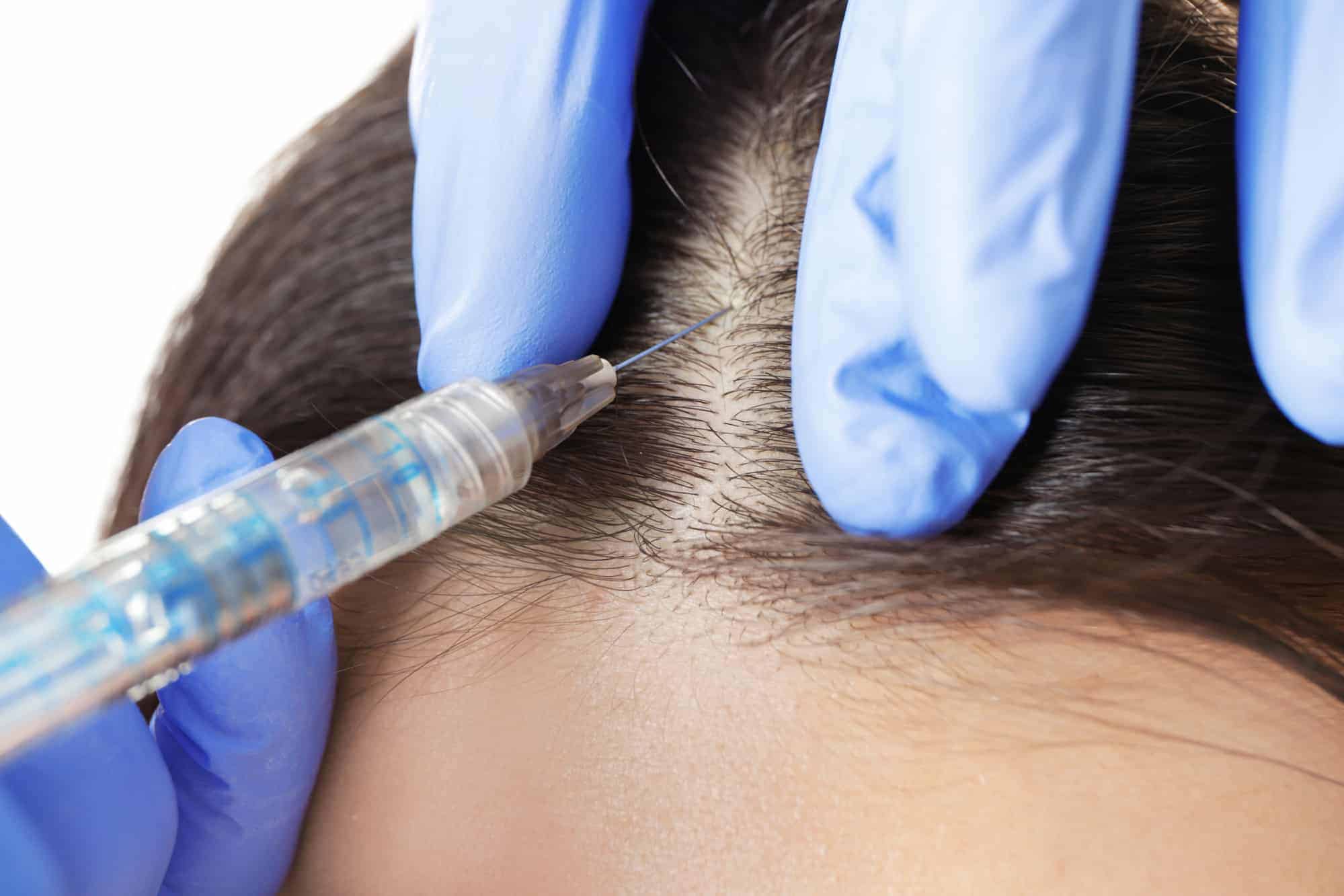 Istanbul haartransplantation für eine jüngere Erscheinung: Die Möglichkeiten erkunden