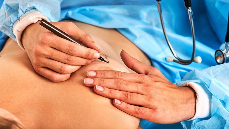 Ästhetische Brustvergrößerung mit Implantaten: Natürliches Aussehen, beste Ergebnisse